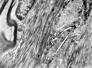 M,3y. | globoid leukodystrophy of Krabbe - n.suralis